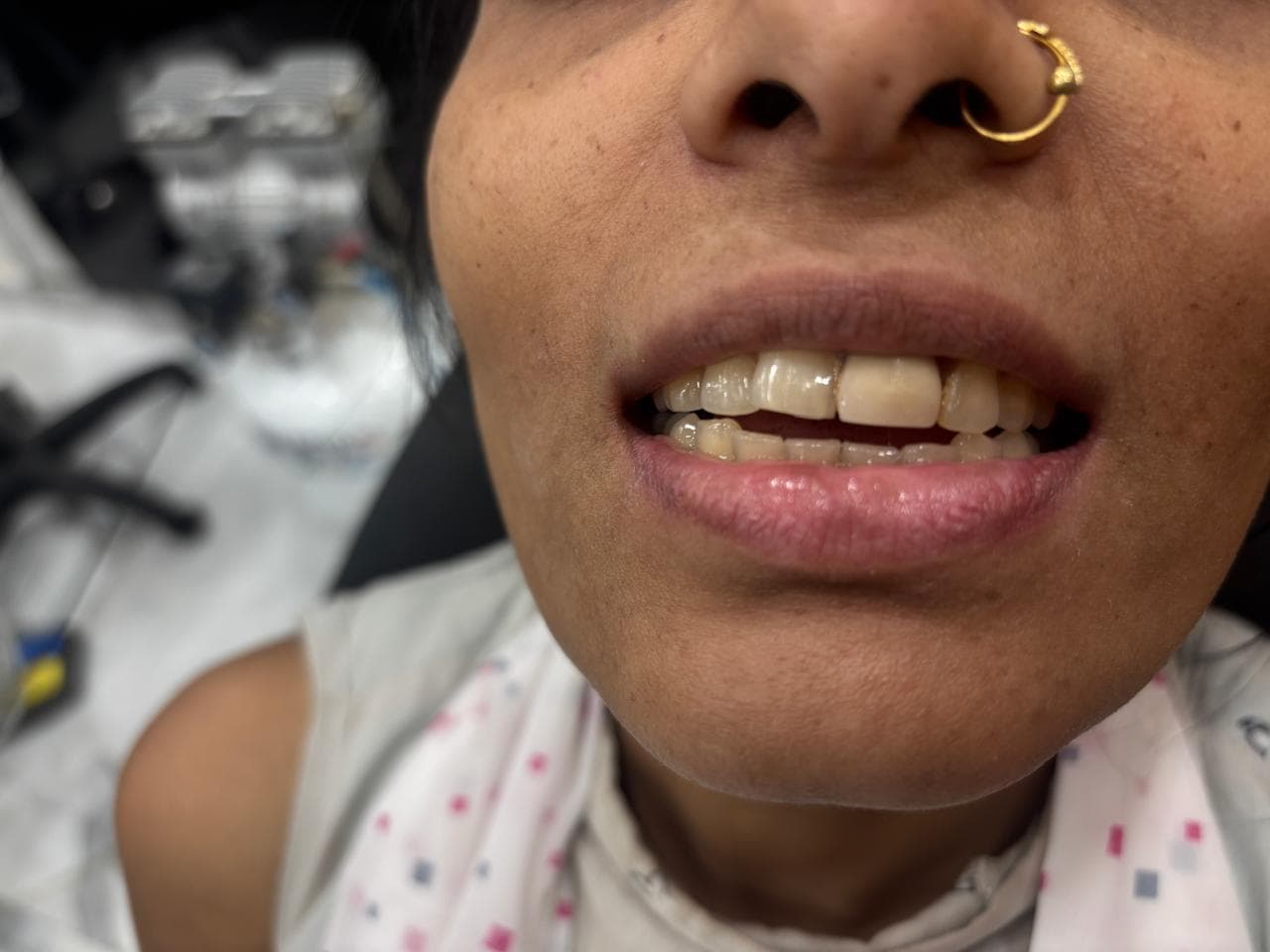 Smile Symmetry Correction