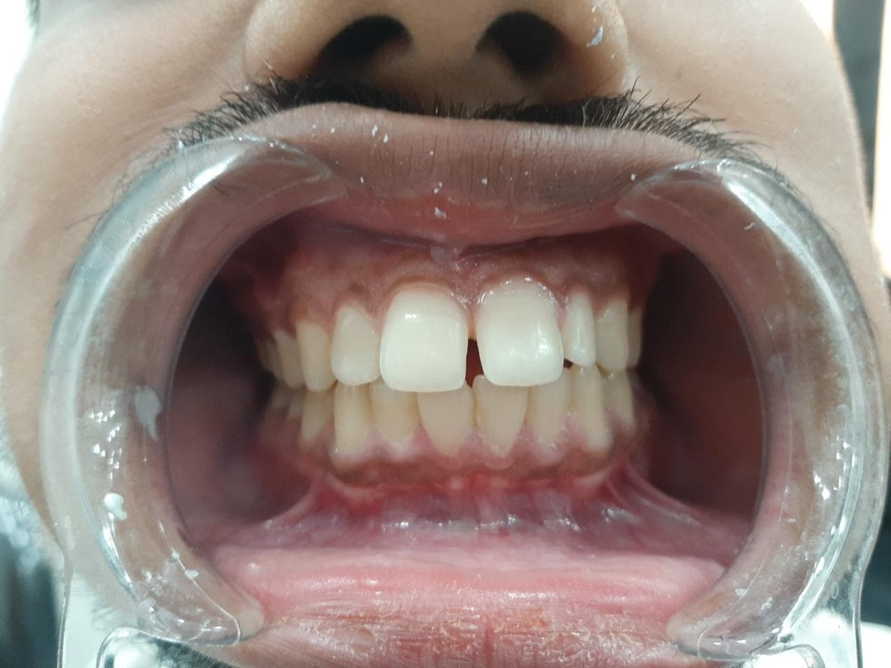 Diastema (Gap) Closure