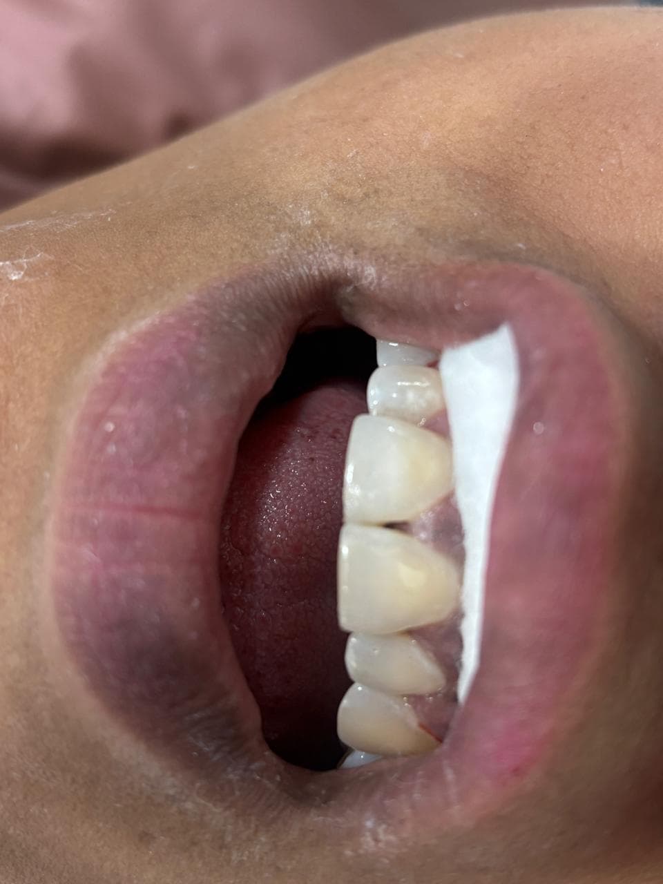 Posterior Bridge Restoration