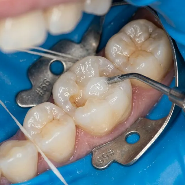 tooth filling in ranchi procedure