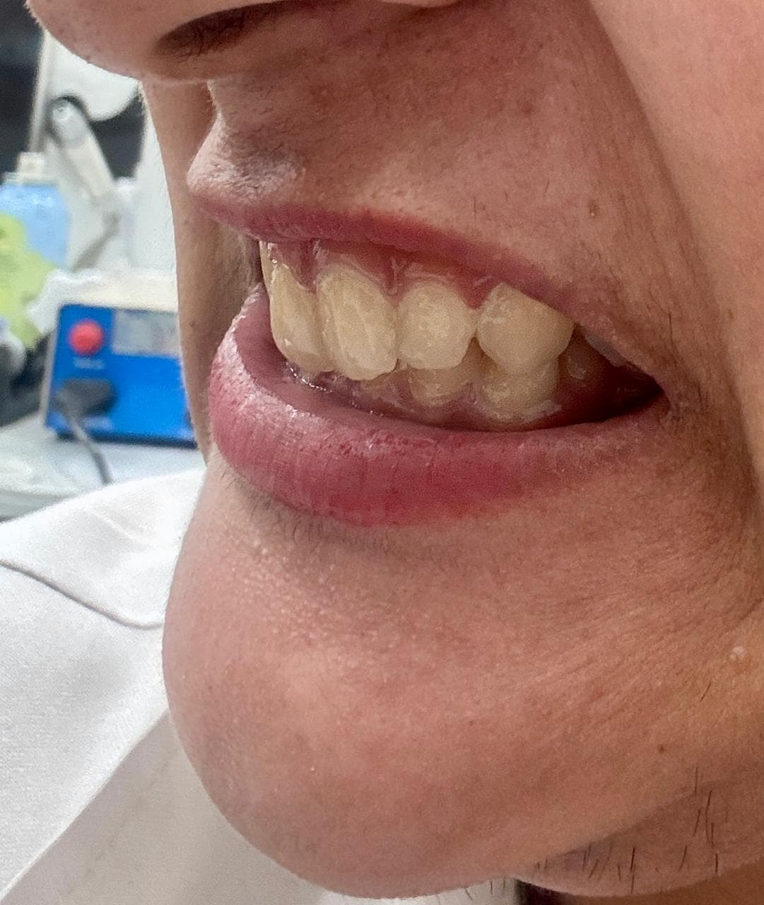 What is Bruxism? Teeth Grinding Symptoms & How to Stop It